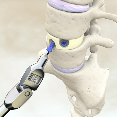 Werkzeug für Banscheiben OP Bild einer Bandscheiben OP