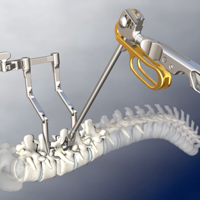 Bandscheiben OP Bandscheibenoperation mit TLIF