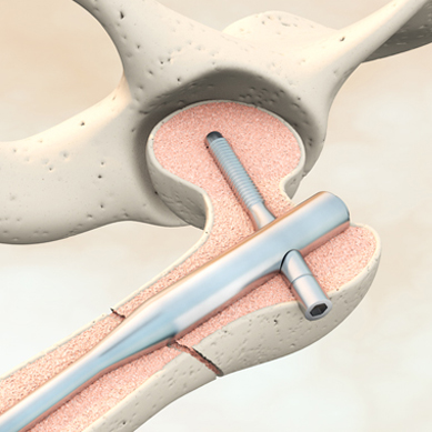 Knochenfraktur Knochenfraktur Implantat